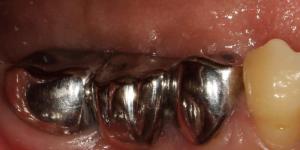 Старые коронки наносят вред здоровью Какой зубной мост не окисляется во рту